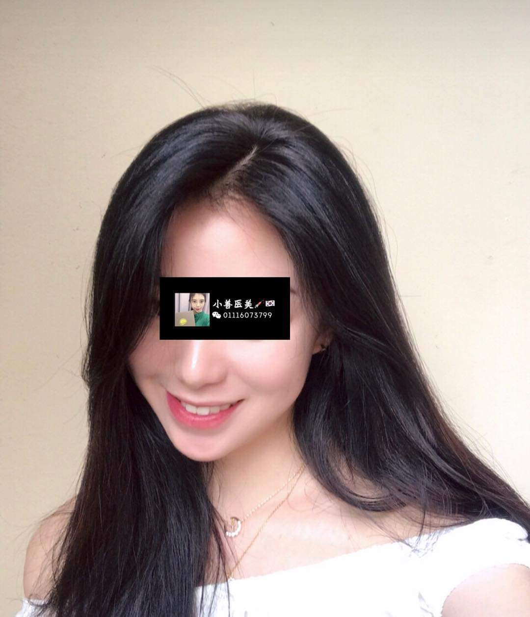  XS 医美微整形 -마이크로 성형56 分鐘�...